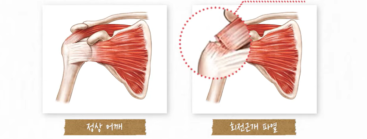 재회전근개파열산재 불승인 재심 이의신청 절차 상담 자료